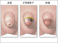 包皮过长手术后图片