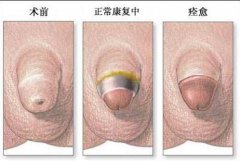 包皮过长图片