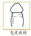 嵌顿性包茎图片