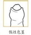 假性包茎图片